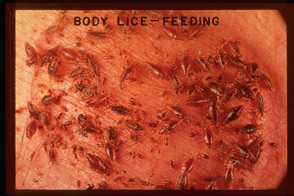 pestweb-body-louse